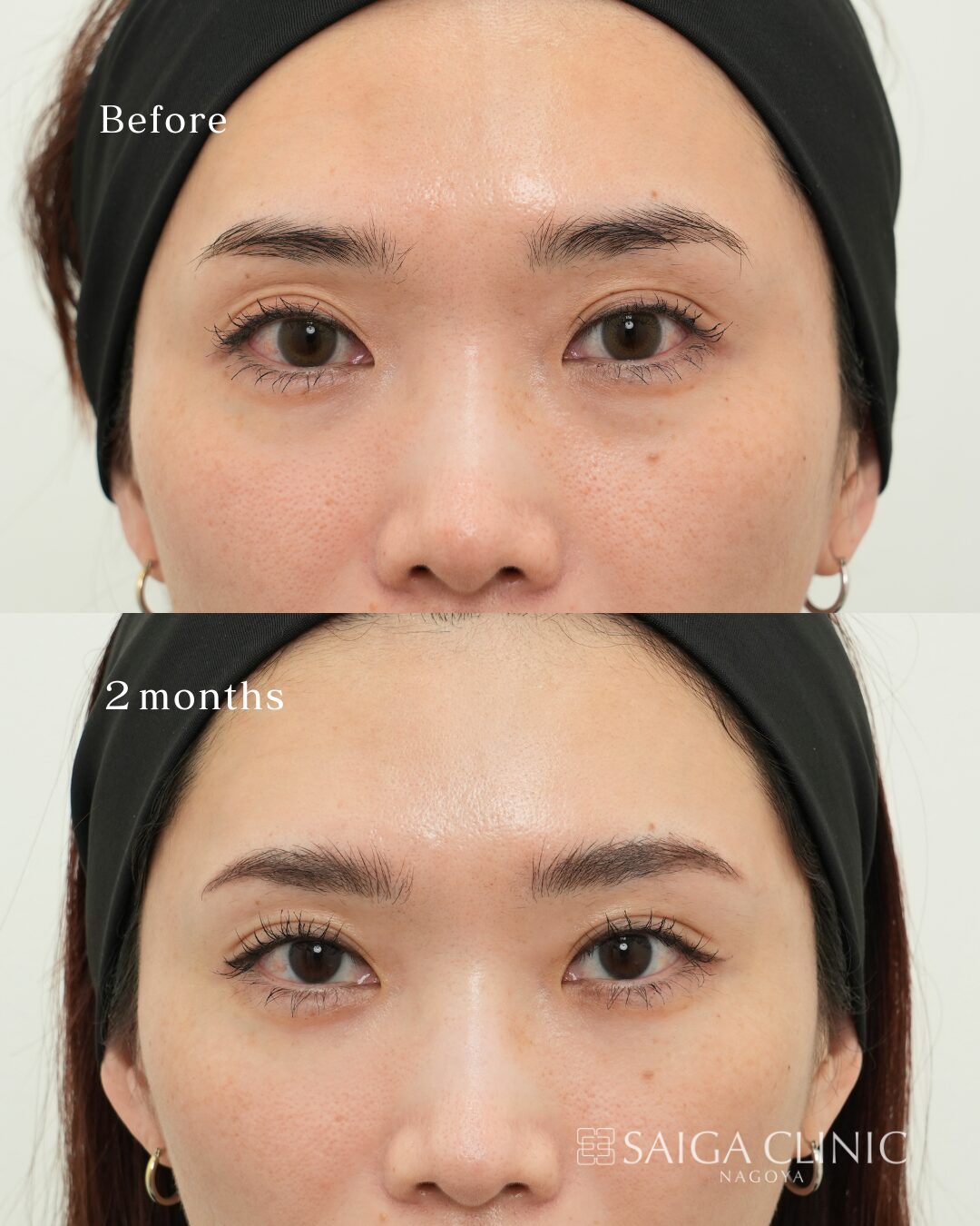 30代女性の裏ハムラ。術前と術後2か月の比較。効果には個人差があります。