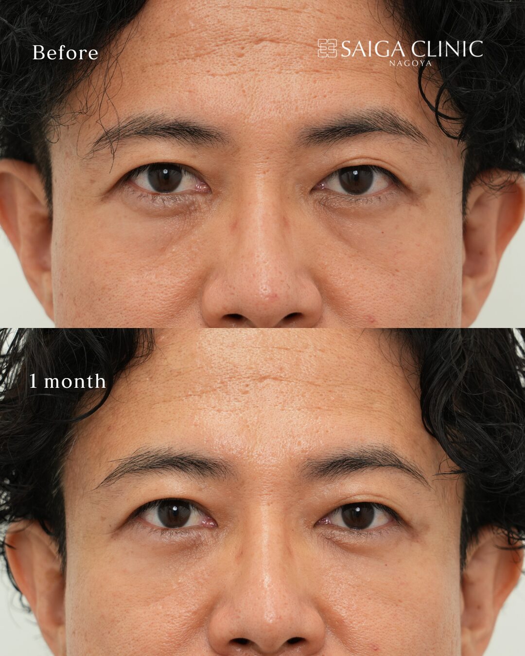 40代男性の裏ハムラ。術前と術後1か月の比較。効果には個人差があります。