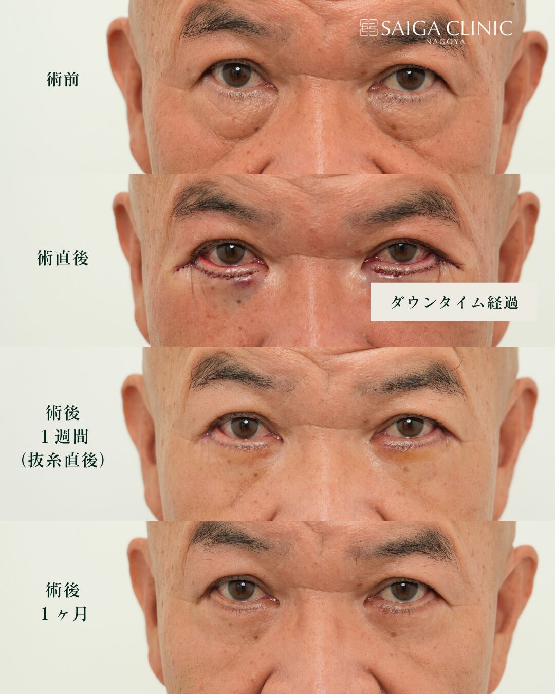 同一患者の表ハムラ経過。術前、術直後、術後1週間の抜糸直後、術後1か月。