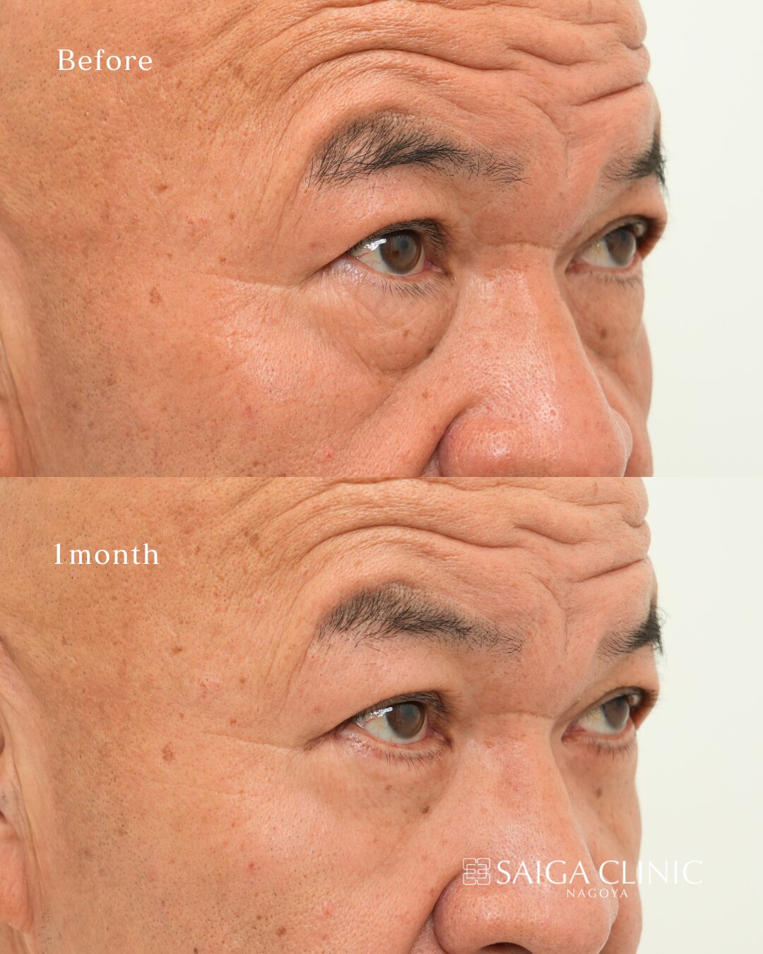 60代男性の表ハムラ。術前と術後1か月の比較。効果には個人差があります。